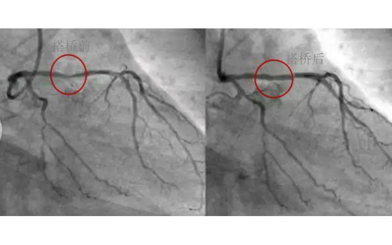 深圳市模具廠對(duì)心臟支架的關(guān)注，國(guó)產(chǎn)化的道路有多長(zhǎng)？